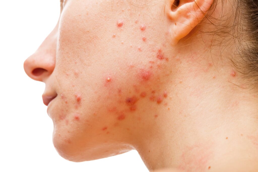 4 Signs You Are Experiencing Hormonal Acne - DermaBlue