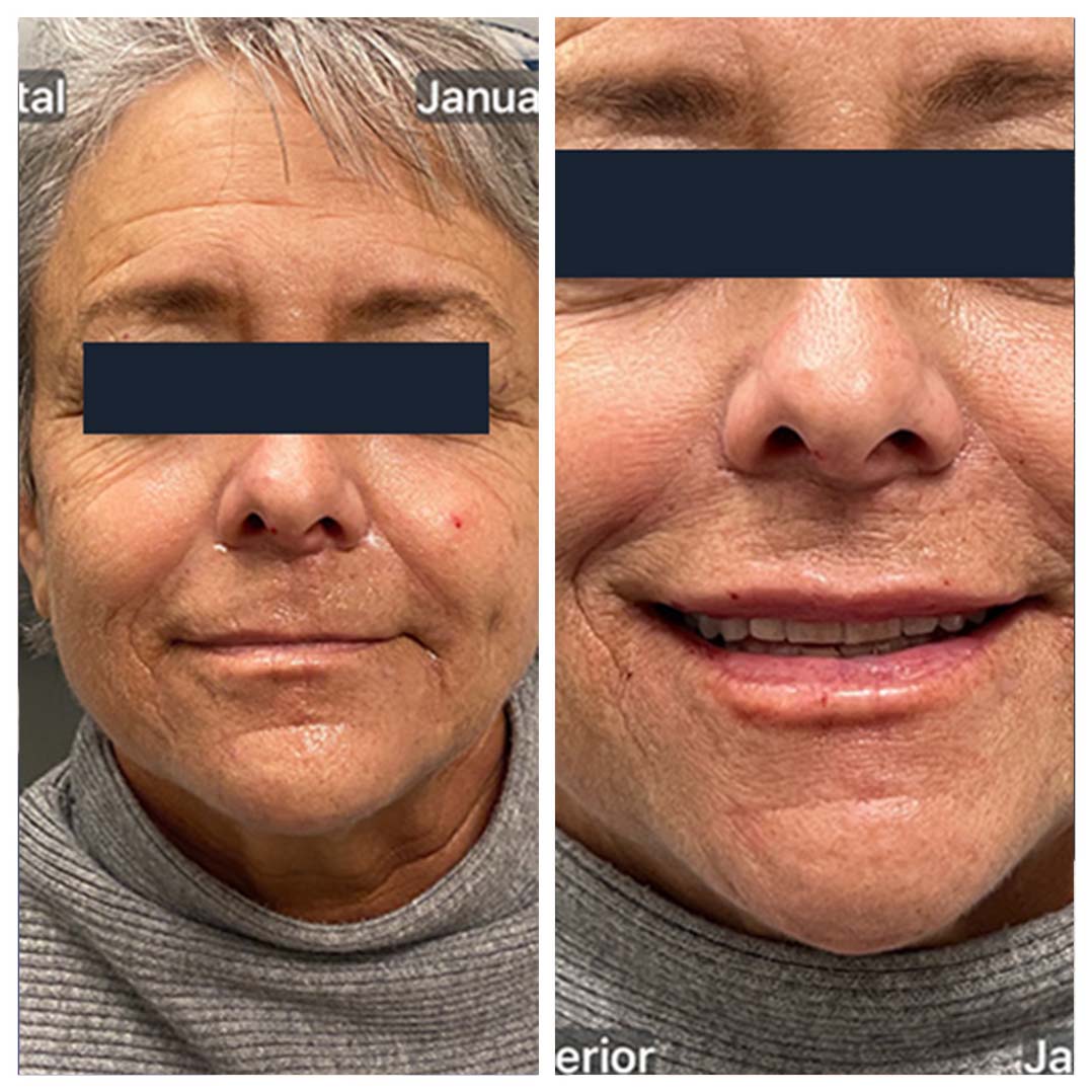 a patient at DermBlue before and after lip fillers