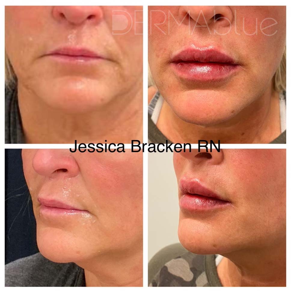 A DermaBlue patient with lip filler before and after