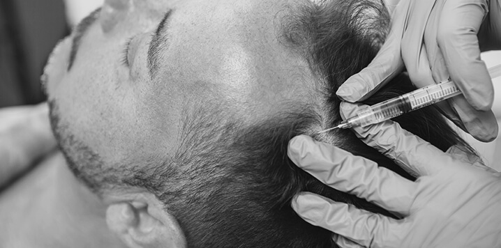 hair growth injections being performed on a man