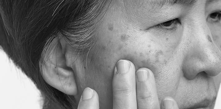 Dark Spots on Face (Melasma): Causes and Treatment
