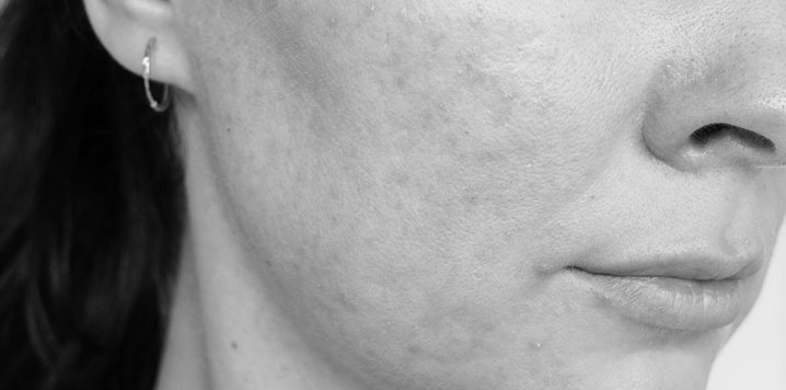 a picture of a woman's face with rosacea