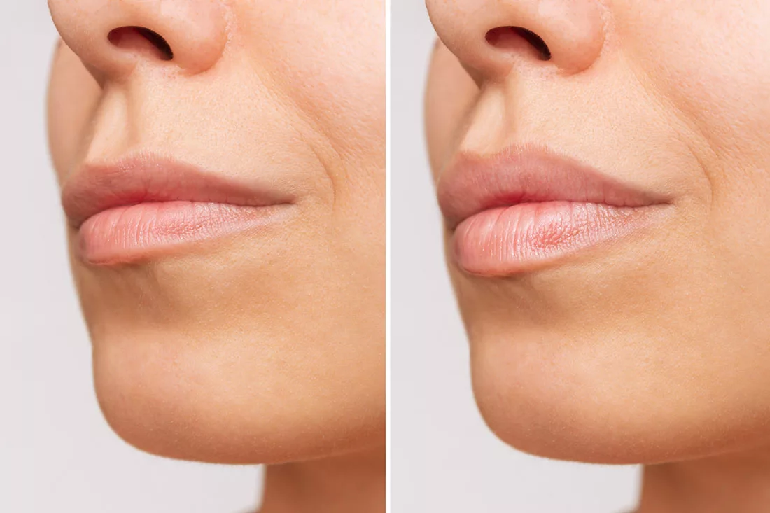 how long can you expect lip fillers to last