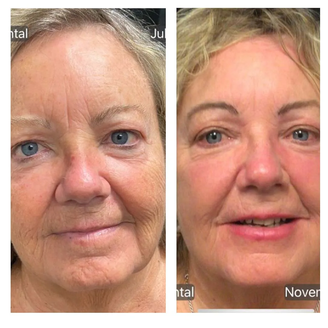 3-Before-After-CO2-Laser-Resurfacing