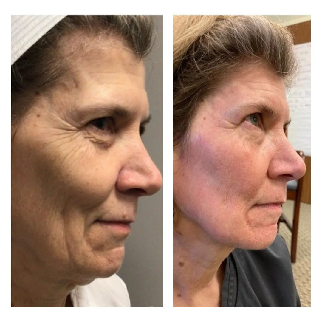 4_CO2-Laser-Resurfacing_Before-After
