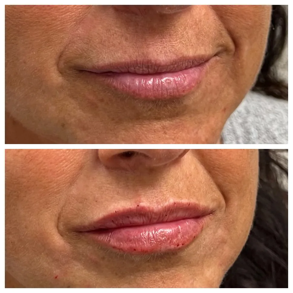 lip filler before and after photo