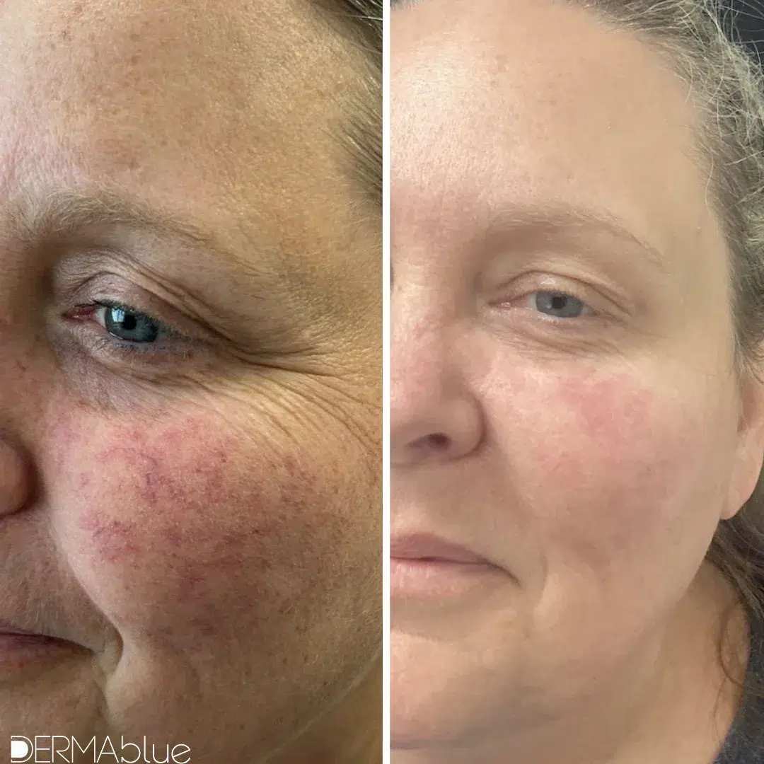 before and after laser vein treatments at dermablue