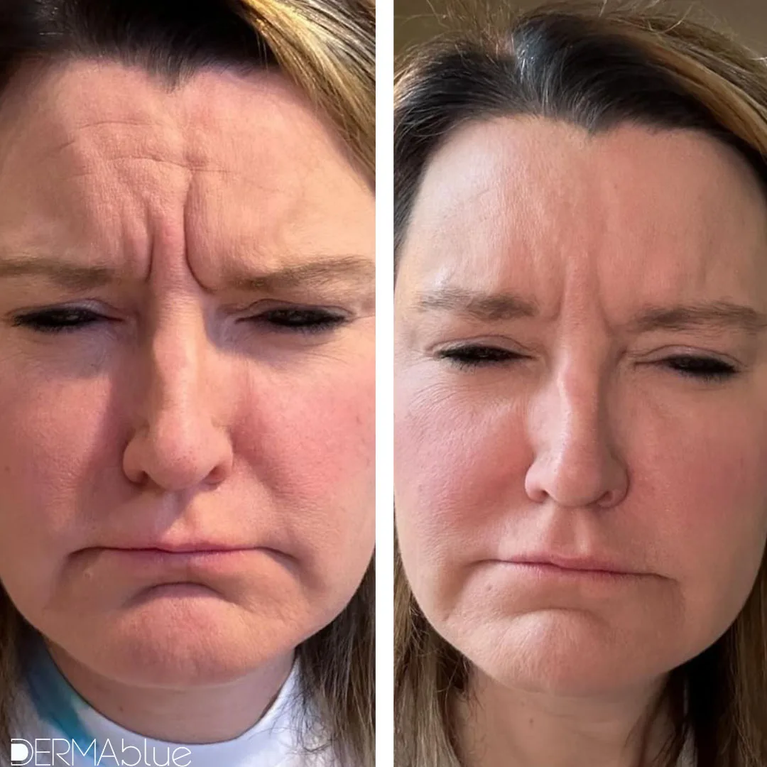 patient showing results before and after botox treatments at dermablue
