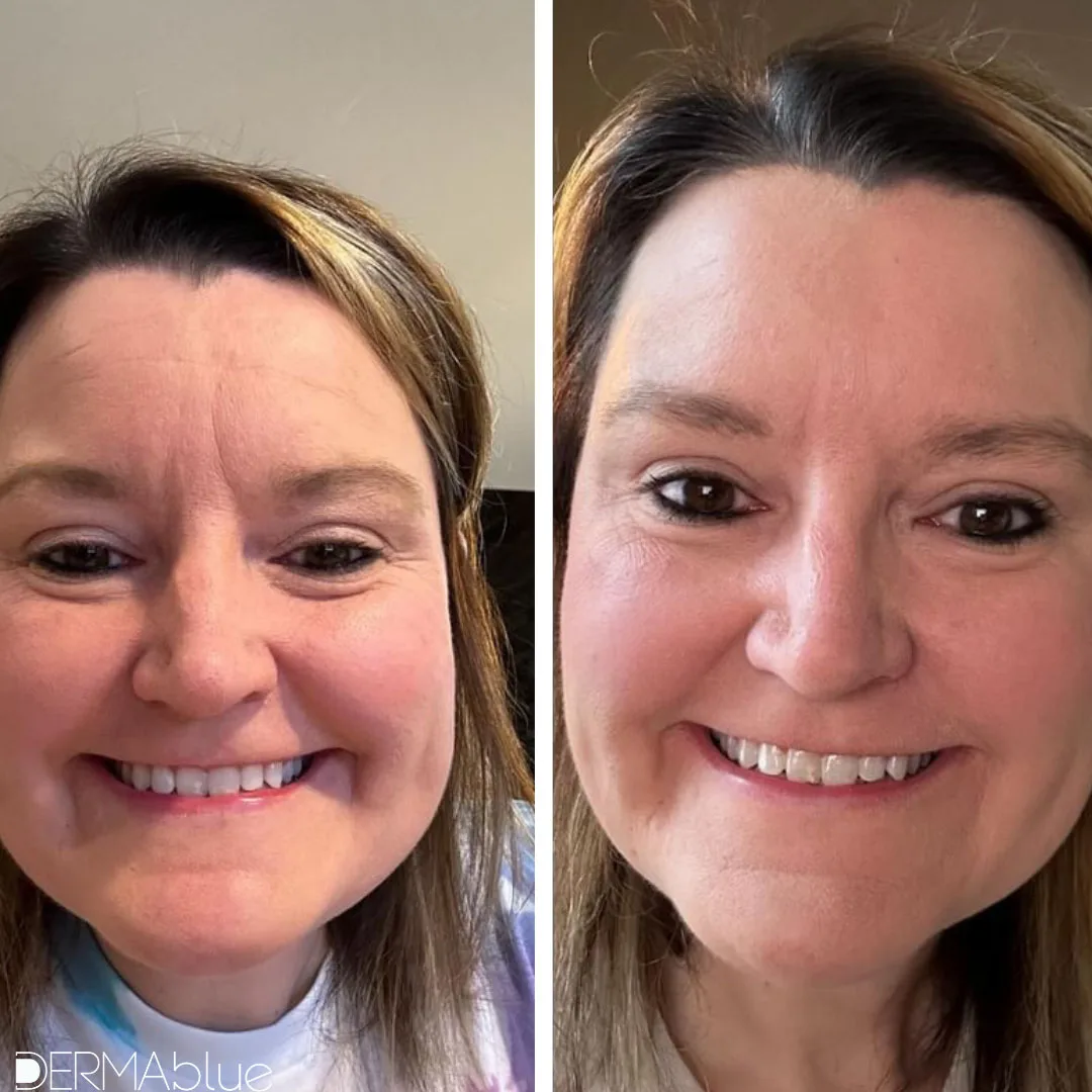 botox before and after treatments