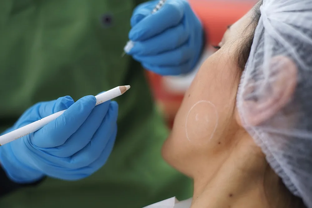 a woman receiving marks on her face for a dermal filler treatment