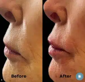 a patient after receiving lip filler at DermaBlue