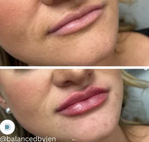 Lip Filler - BA