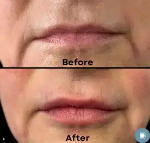 Lip Filler