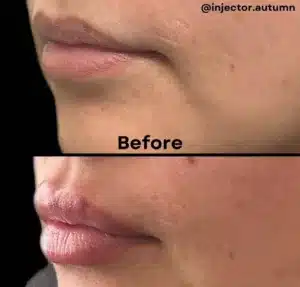 Lip Filler - Before and After
