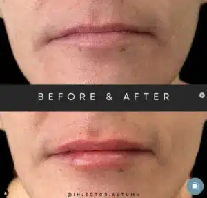 lip filler before and after photo