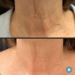 RF microneedling series of 4 on neck
