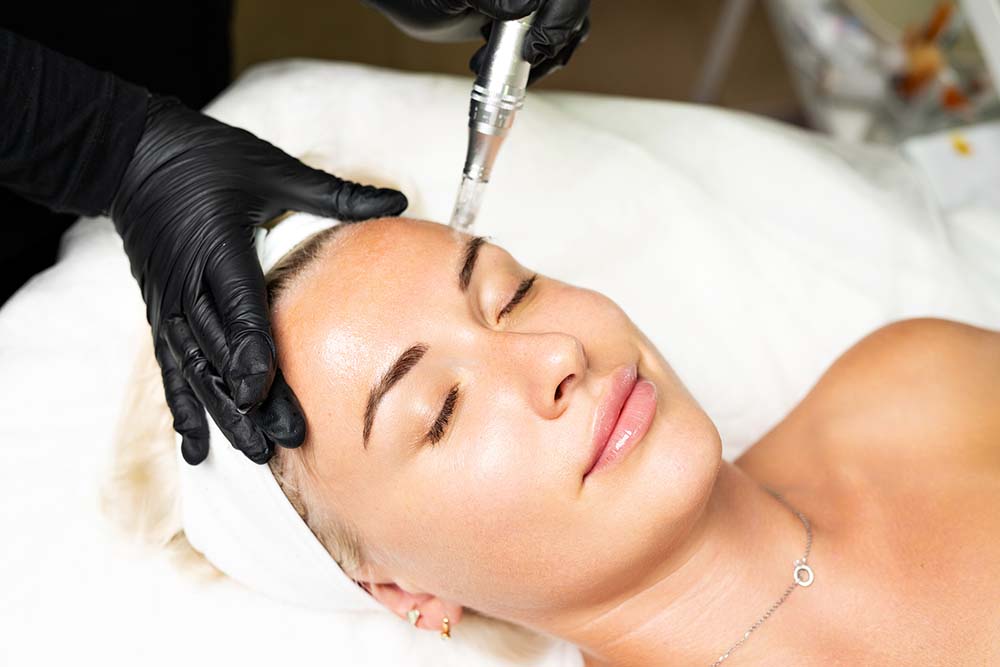 a woman receiving a microneedling treatment