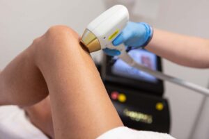 laser hair removal asheville