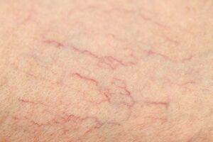 laser vein therapy treatments