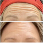 botox results on the forehead