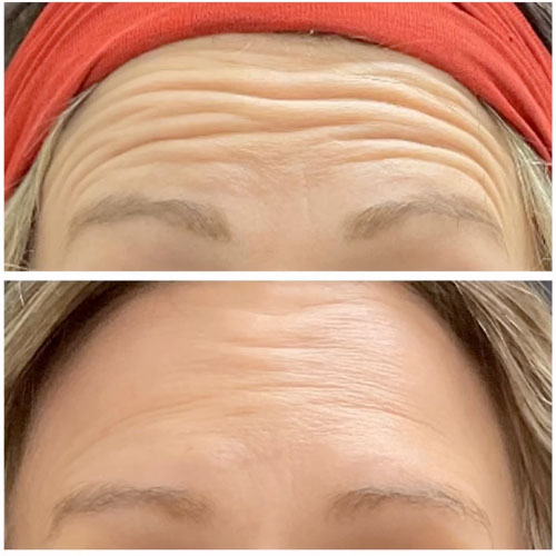 botox results on the forehead