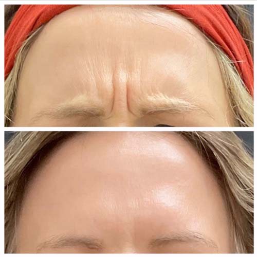 botox forehead - before and after