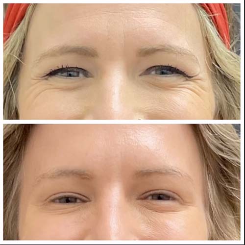 botox forehead - before and after