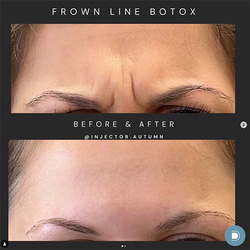 botox frown line before and after