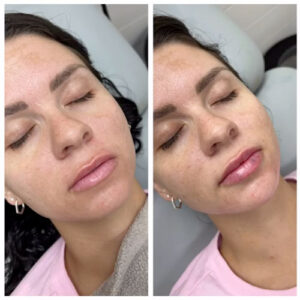 chin and lip filler before and after