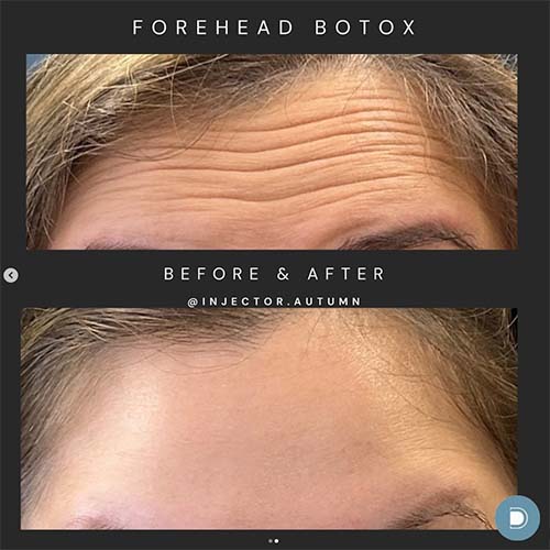 forehead botox results