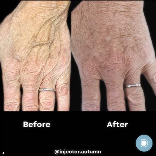 sculptra - bioactive filler - hands - before and after