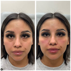 under eye filler before and after