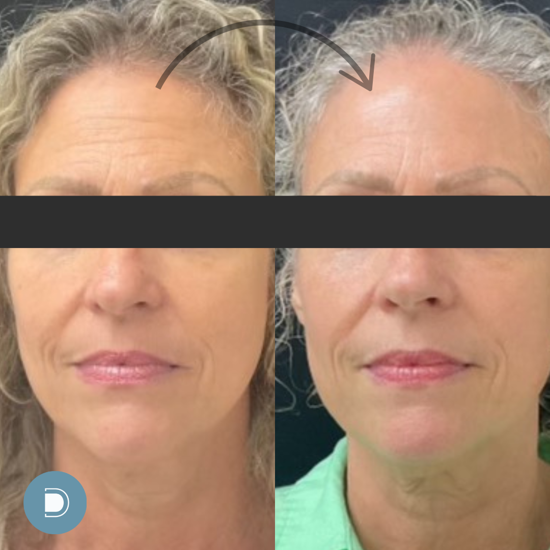 laser resurfacing results