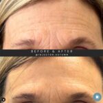 botox before and after treatment at dermablue hendersonville nc