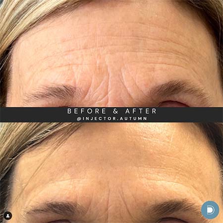 botox before and after treatment at dermablue hendersonville nc