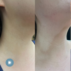 Skinvive results - neck