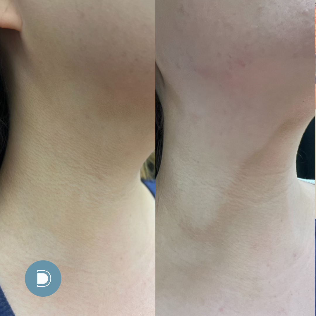 Skinvive results - neck