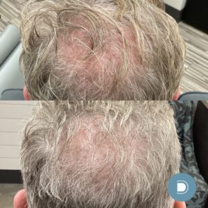 laser hair restoration - before and after 2 treatments - dermablue