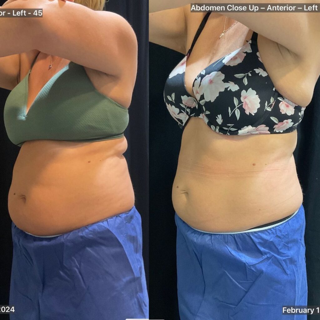 coolsculpting ba (2)