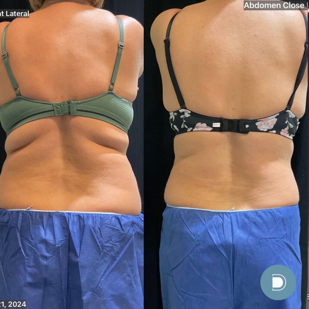 coolsculpting before and after (1)