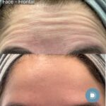 botox results for the forehead