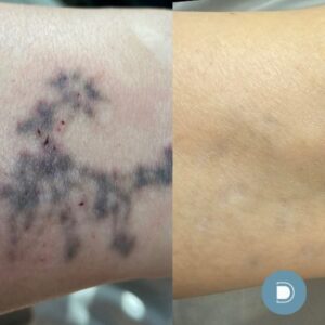 tattoo removal results at DermaBlue