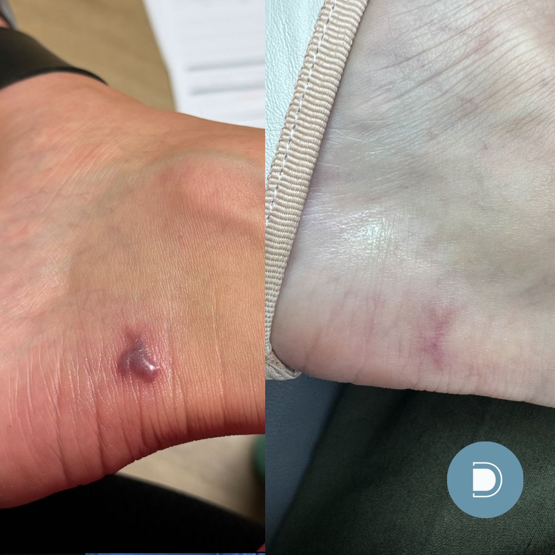 DermaV - scar reduction results on foot- 3 treatments