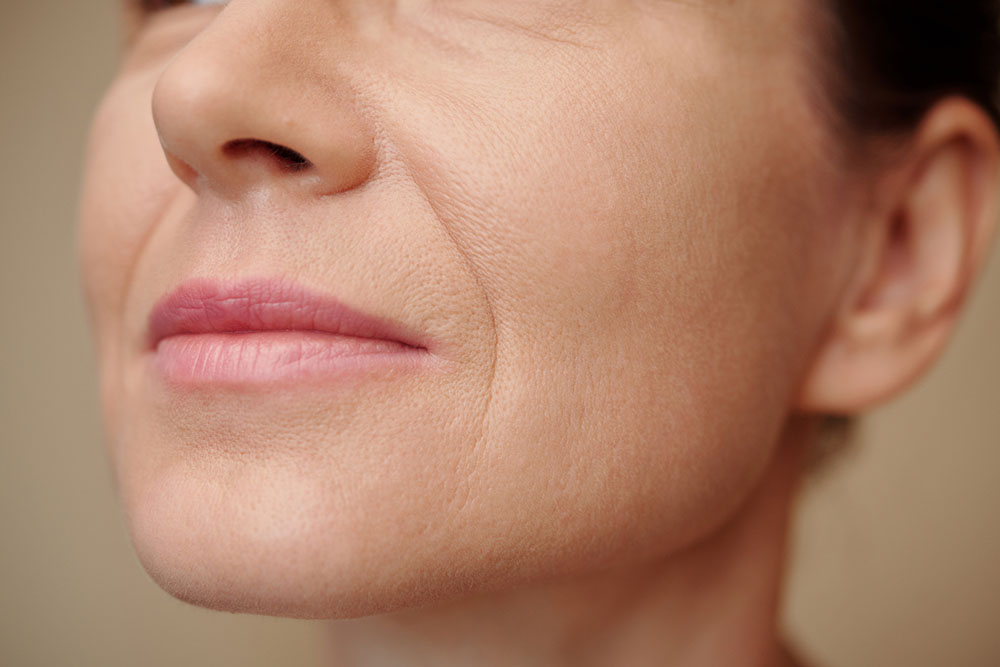 a woman with smooth skin after microneedling with PRF treatment
