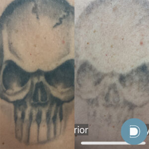 Laser Tattoo Removal