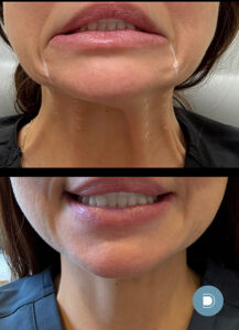a woman showing off her neck after a nefertiti lift at DermaBlue