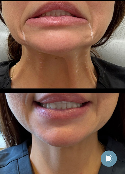 a woman showing off her neck after a nefertiti lift at DermaBlue