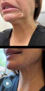 a woman showing off her neck after a nefertiti lift at DermaBlue