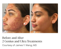 before and after 2 genius and ultra treatments