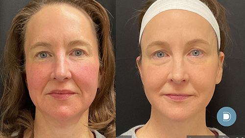 2_dermav-rf-microneedling-ultra-glo.jpg
